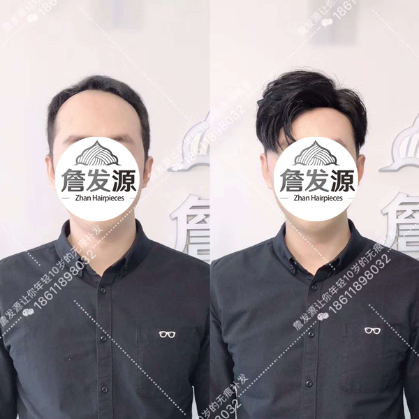 抚顺小哥之前补发效果不好，在詹发源补完后特