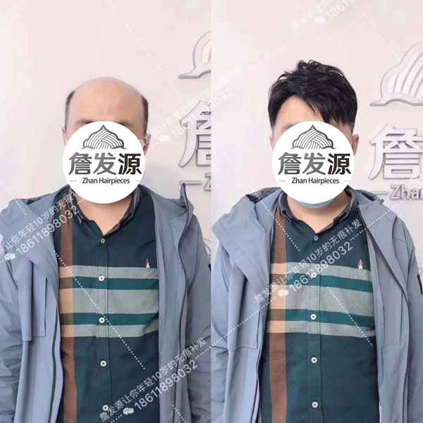 铁岭兄弟戴了10年假发称赞还是詹发源的好！